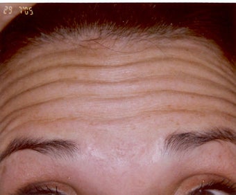 Botox before 469290