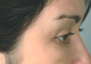 Latisse for eyelashes before 151333