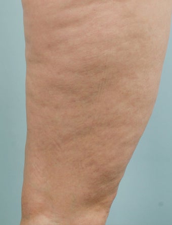 Smart Lipo before 606717