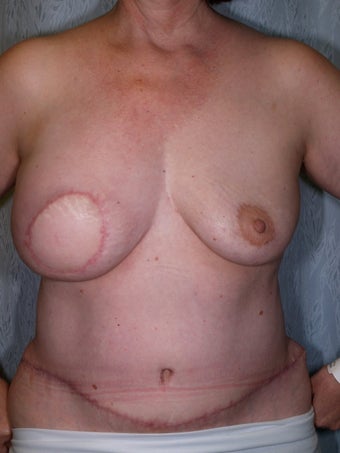DIEP Flap Breast Reconstruction after 523524