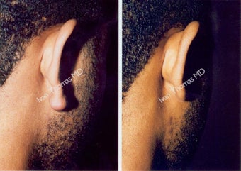 Earlobe Surgery before 243325