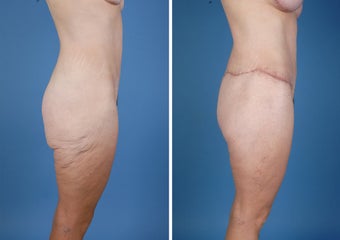 Flank Excision 303674