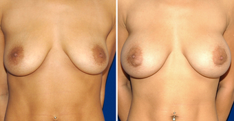 Breast Implants before 494499