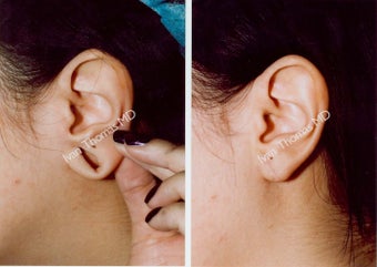 Earlobe Surgery before 243330