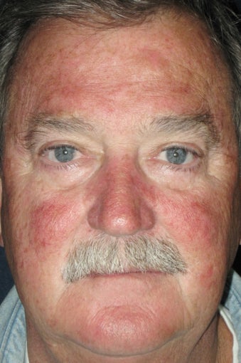 Photodynamic Therapy before 486589