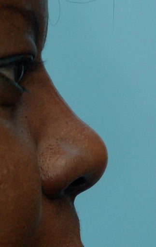 Rhinoplasty, Non-Surgical after 134443