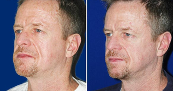 Sculptra after 496291
