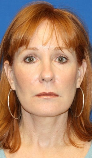 2 years post op: Facelift, Lower Eyelid Skin Pinch, and Peri-orbital Fat Transfer after 424184