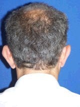Ear Surgery (Otoplasty) 357660