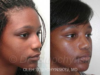 African American Rhinoplasty before 374013