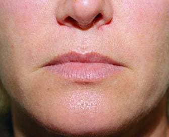 Lip lift, corner of lip lift, and filler in lips before 299913