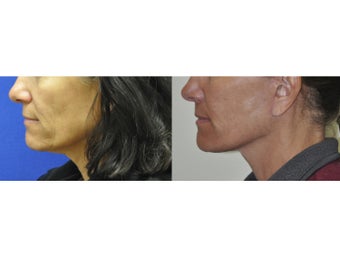 Lower Facelift/Neck LIft before 519067
