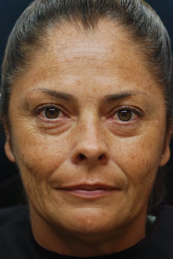 Sculptra Aesthetic before 581305