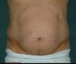 Lipo to Tummy before 478031