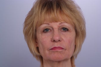 Laser Resurfacing after 253081