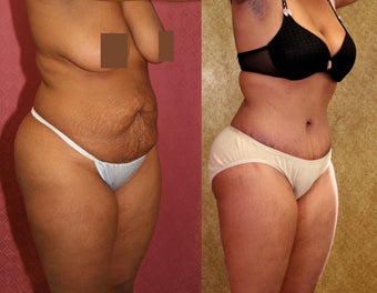 tummy tuck before 304680