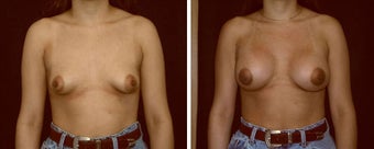 32 year old female, breast augmentation before 628413