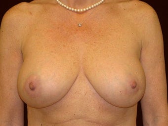 Breast augmentation after 293954