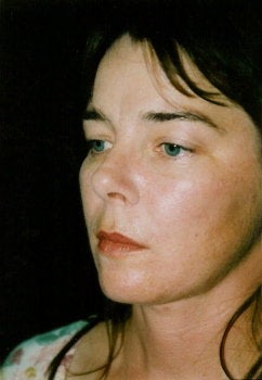Facelift / Neck Lift after 360838