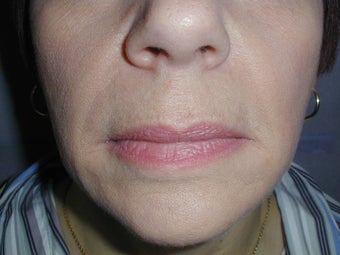 Restylane for smile lines (nasolabial folds) after 100945