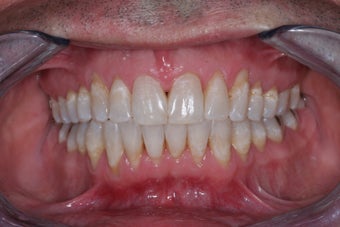 Invisalign after 372594