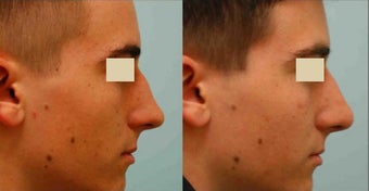 Revision/Corrective Rhinoplasty before 136563
