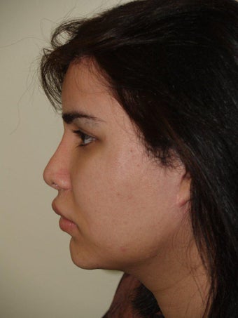 Revision Rhinoplasty before 352602