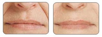Before and after Restylane around mouth before 6290