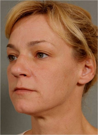 41 Year Old Female Treated for sun damage, wrinkles, and acne scars 645384