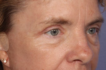 Eyelid Surgery after 324137