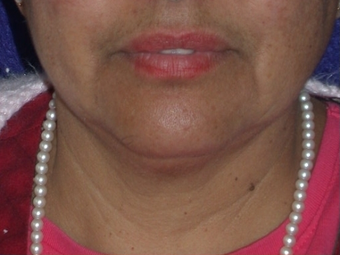 Necklift before 208453