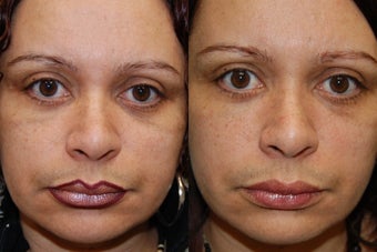 Silikon-1000, Permanent Injectable Filler for Lower Eyelid Bags before 140478