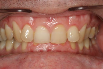 Invisalign Treatment before 92848