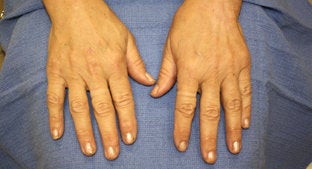 Radiesse Hands after 494484