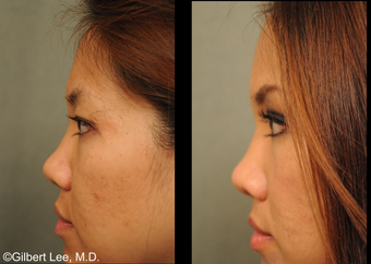 Asian Double Eyelid Surgery after 381166