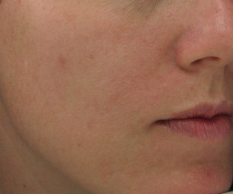 Hyperpigmentation treated with Obagi for 3 months after 52832