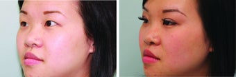 Double Eyelid Surgery Suture 548933