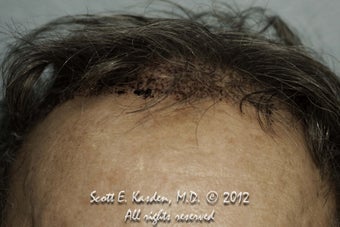 AccuGraft Hair Transplant after 589495