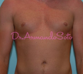 Pectoral Implants for Men before 564468