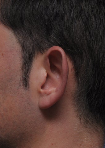 Otoplasty 361344