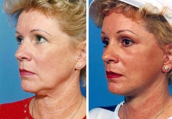 Facelift before 643025