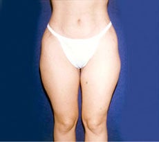 Smartlipo before 401653