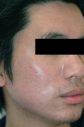 Laser Acne Treatment after 89124