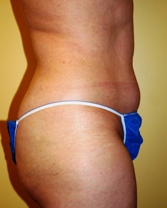 Body Jet (water assisted) liposuction before 235770