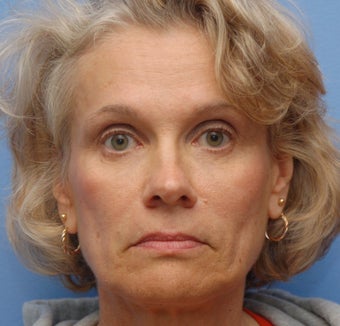 Liquid Facelift for Nasolabial Folds after 104598