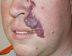 Pulsed Dye Laser before 478044