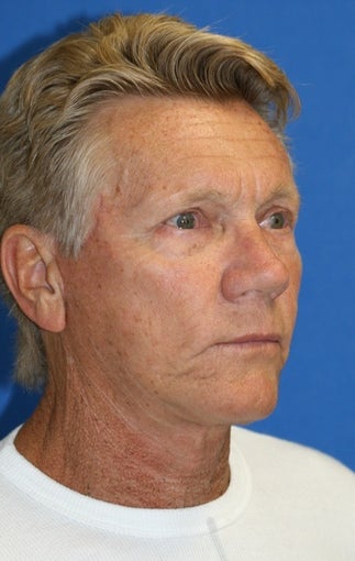 Facelift, Upper Blepharoplasty, Lower Blepharoplasty, & Lower Eyelid Skin Pinch 514805