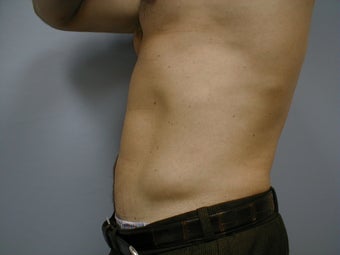 Male contouring liposuction 590924