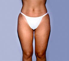 Smartlipo after 401653
