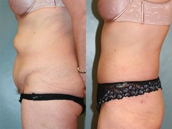 Tummy Tuck before 218301